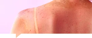 Betacaroteno para la piel: beneficios contra manchas y quemaduras