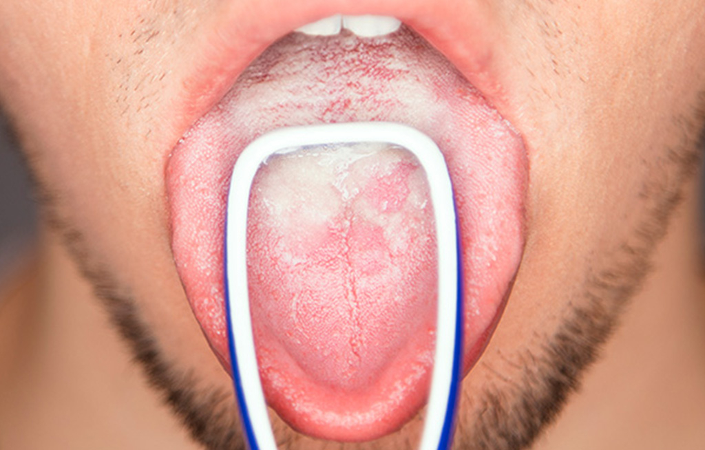 Candidiasis