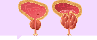 Hiperplasia Benigna de Próstata